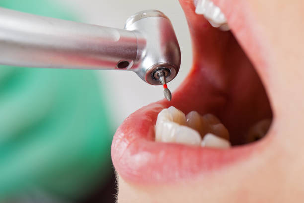 Teeth Whitening in AK